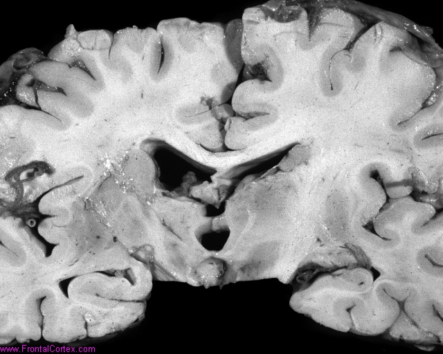 TS_subependNodules